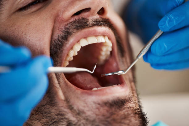Best Emergency Dentist for Knocked-Out Tooth in Thonotosassa, FL
